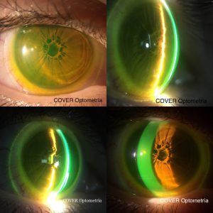 Lente de Contacto RPG de apoyo Escleral adaptada en paciente con miopía alta y MPP (Verdejo A, COVER)