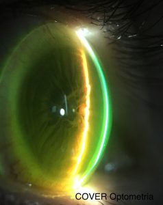 Imagen de la condición ocular vista mediante iluminación directa (paralelepípedo) la lente escleral y mediante retroiluminación la MPP