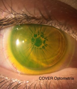 Imagen de la condición ocular vista lateral mediante iluminación directa (sección óptica) el menisco lagrimal entre lente-córnea y mediante retroiluminación la MPP